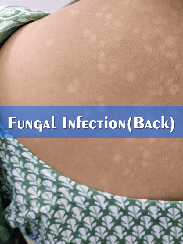 Fungal Infection Back